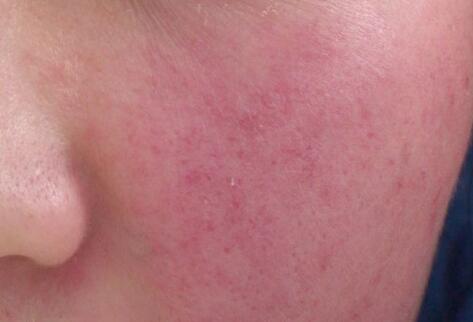 如何拯救你的敏感肌？廣西南寧美容培訓(xùn)叫你正確方法