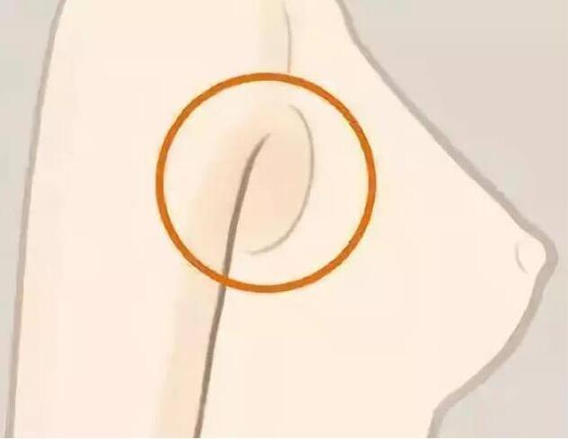 減副乳，瘦手臂一招就解決！