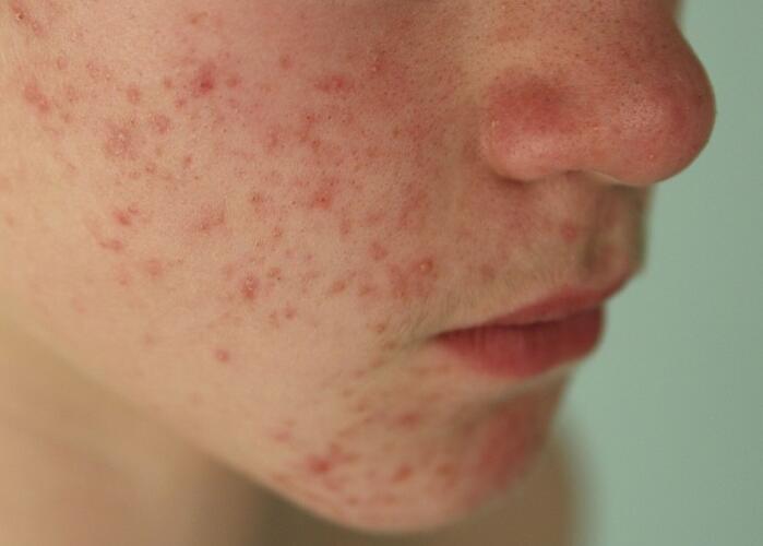 粉刺閉口應(yīng)該如何處理？