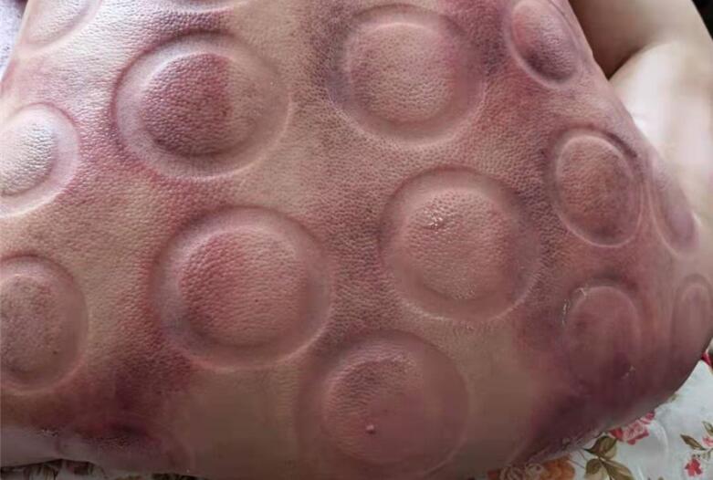 怎樣拔火罐？南寧美容學(xué)校手把手教你