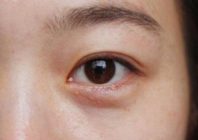 黑眼圈的種類有哪些？廣西美容培訓(xùn)教你保養(yǎng)