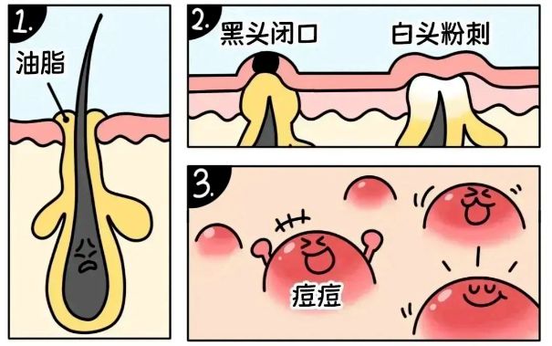 不同部位閉口形成的原因，南寧美容護膚學校解答