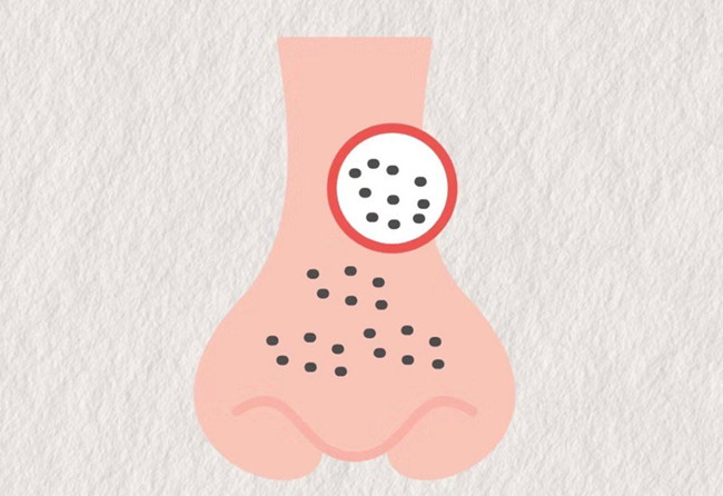 廣西皮膚管理師：面對(duì)嚴(yán)重的黑頭應(yīng)該怎么辦？